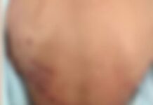 Raio em ato público: adolescente ferido durante evento recebe alta após dias de apreensão